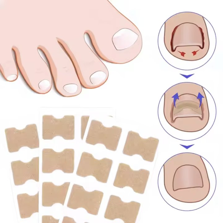 Toe Nail Correction Patch – Painless Physical Stretching, Glue-Free